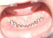 Dental Implant