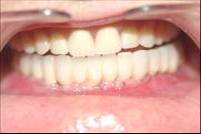Dental Implant