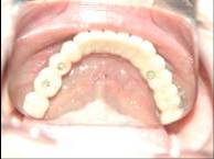 Dental Implant