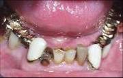 Dental Implant