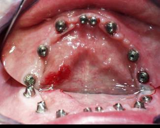 Dental Implant