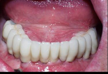 Dental Implant