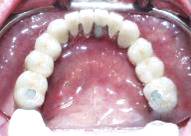 Dental Implant