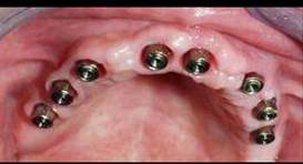 Dental Implant