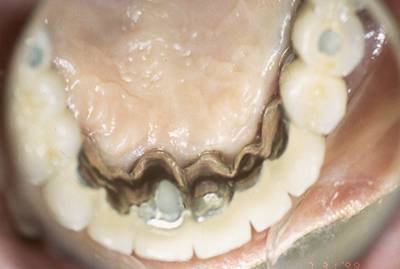 Dental Implant