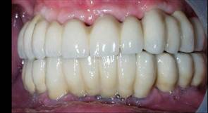 Dental Implant